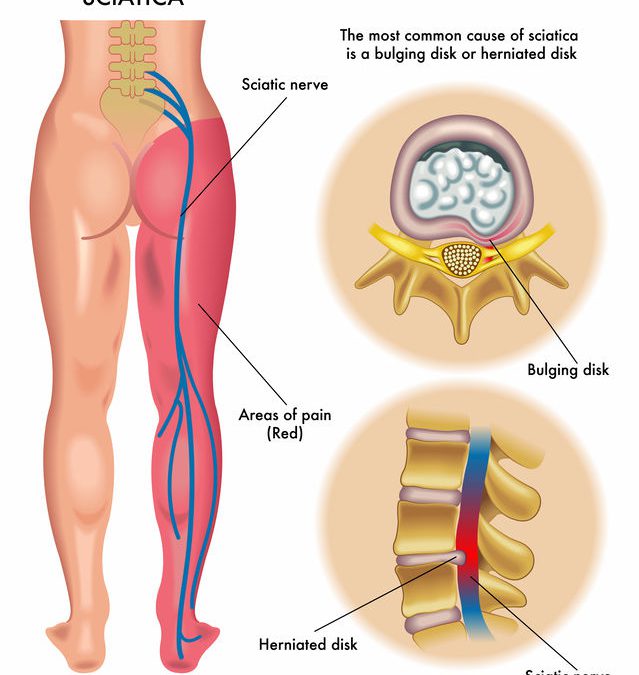Isjias og isjas illustrert med radierende smerter. Radierende smerter kalles også strålesmerter og nerverotsmerter