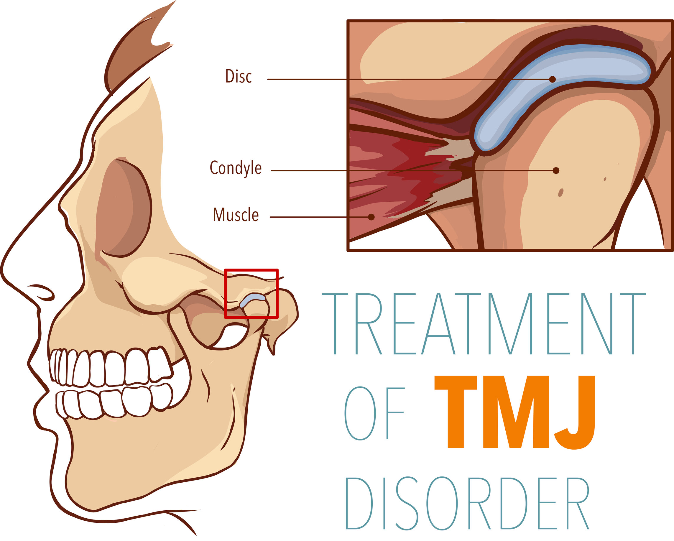 kjeveplager og kjevesmerter bildet er en illustrasjon av TMJ