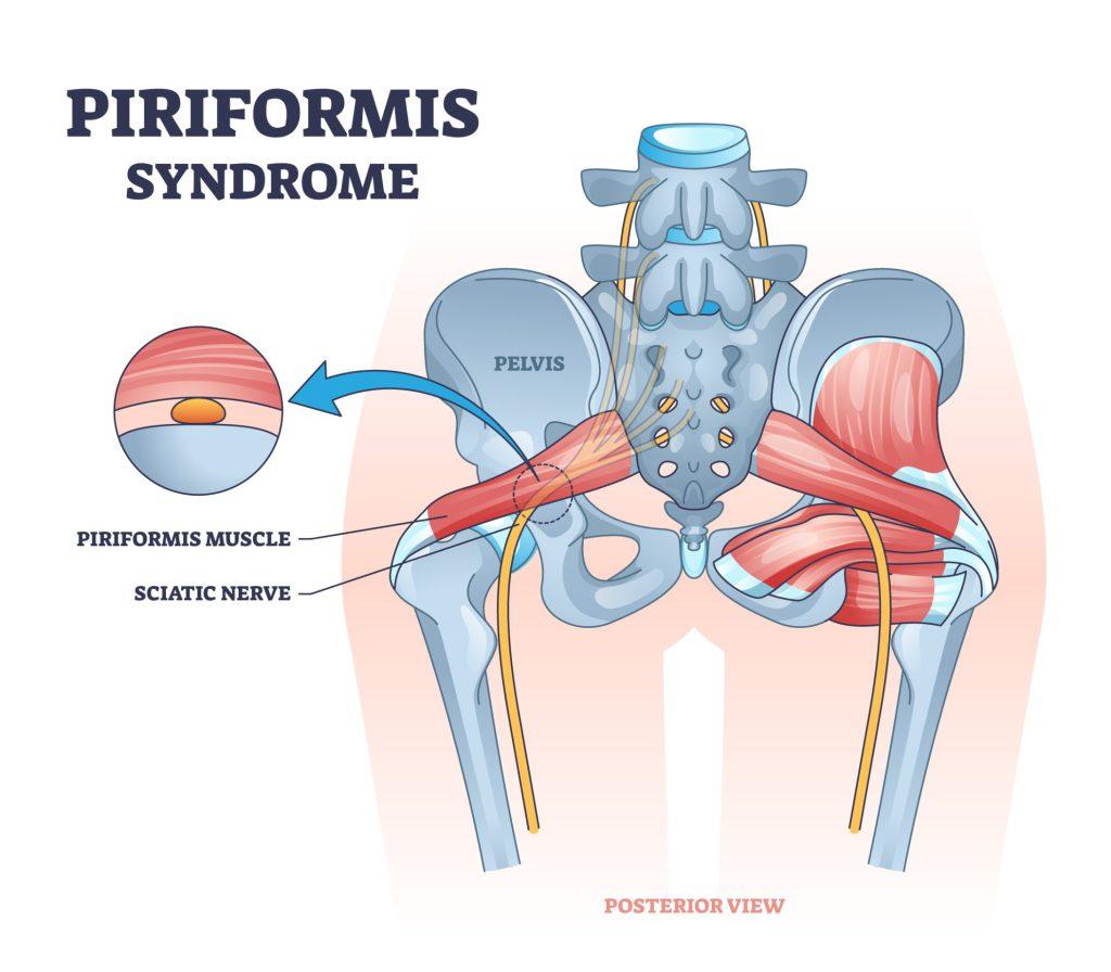 Piriformis syndrom kommer av at isjias nerven går i nærheten av muskelen. Noen ganger går isjiasnerven gjennom piriformismuskelen. Bildet illustrerer piriformis og nerven sitt forløp fra ryggraden