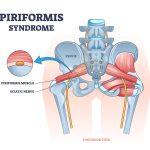 Piriformis syndrom: 1 komplett guide