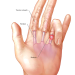 Triggerfinger - årsak, behandling og øvelser