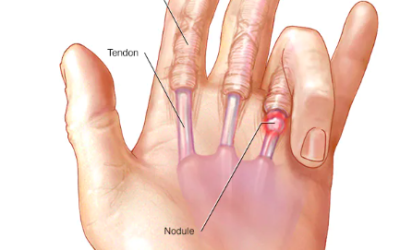 Triggerfinger – årsak, behandling og øvelser
