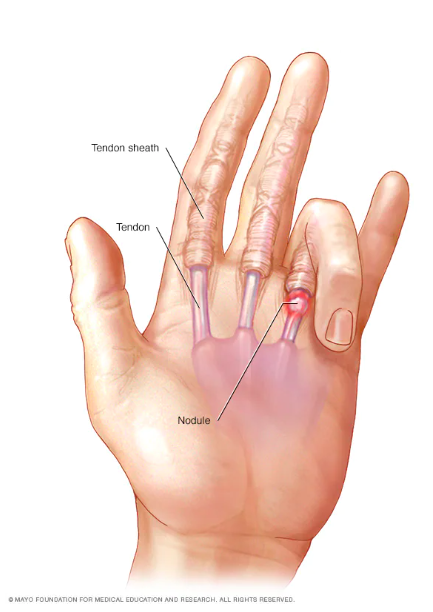 Triggerfinger behandling og årsak
