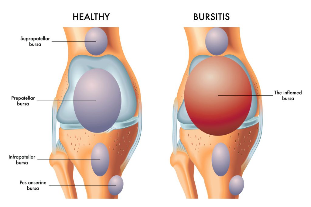 Bursitt i kne sammenlignet med vanlig friskt kne. Det finnes mange knebursitter, på denne illustrasjonen er det bursitt i den prepatellare bursa