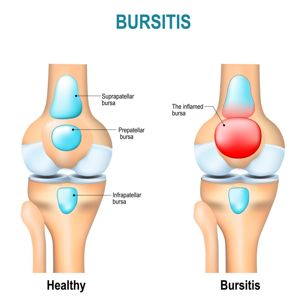 Bilde som illustrerer forskjellen på et friskt kne og et med kne bursitt 
