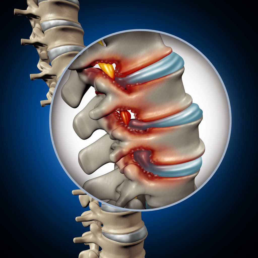 illustrasjon av spinal stenose i lumbalen grunnet slitasjeskader.