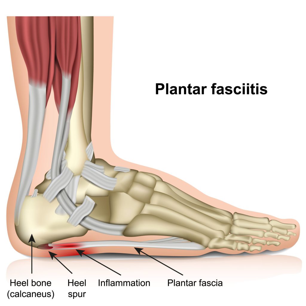 smerter under foten kan komme av både plantar fascitt og hælspore. Bildet er en illustrasjon over hvordan både hælspore og plantar fascitt utvikles