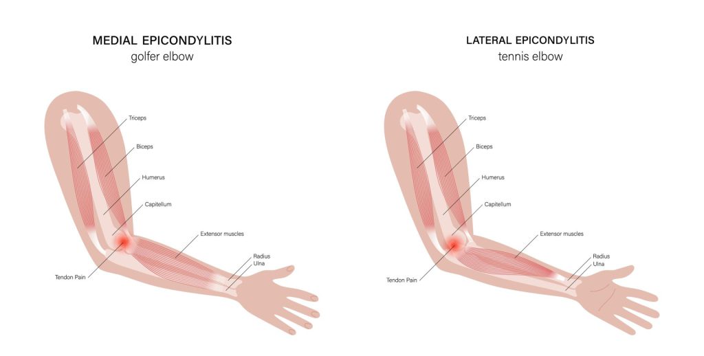 senebetennelse arm: bildet viser både tennisalbue og golfalbue også igjen kalt lateral og medial epikonsylitt.