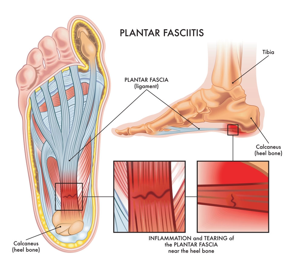 vondt under foten er ofte grunnet en tilstand som heter plkantar fasciit. bildet er en figur som forklarer hva dette er